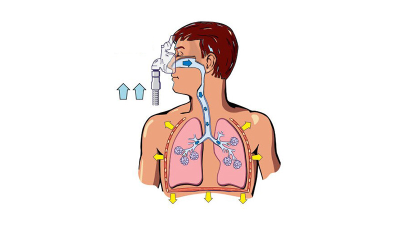慢阻肺用呼吸机有用吗?慢阻肺什么程度需要使用呼吸机?